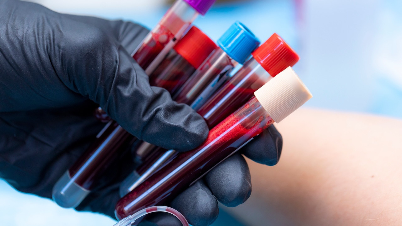 Bazı kan gruplarında felç riski daha fazla