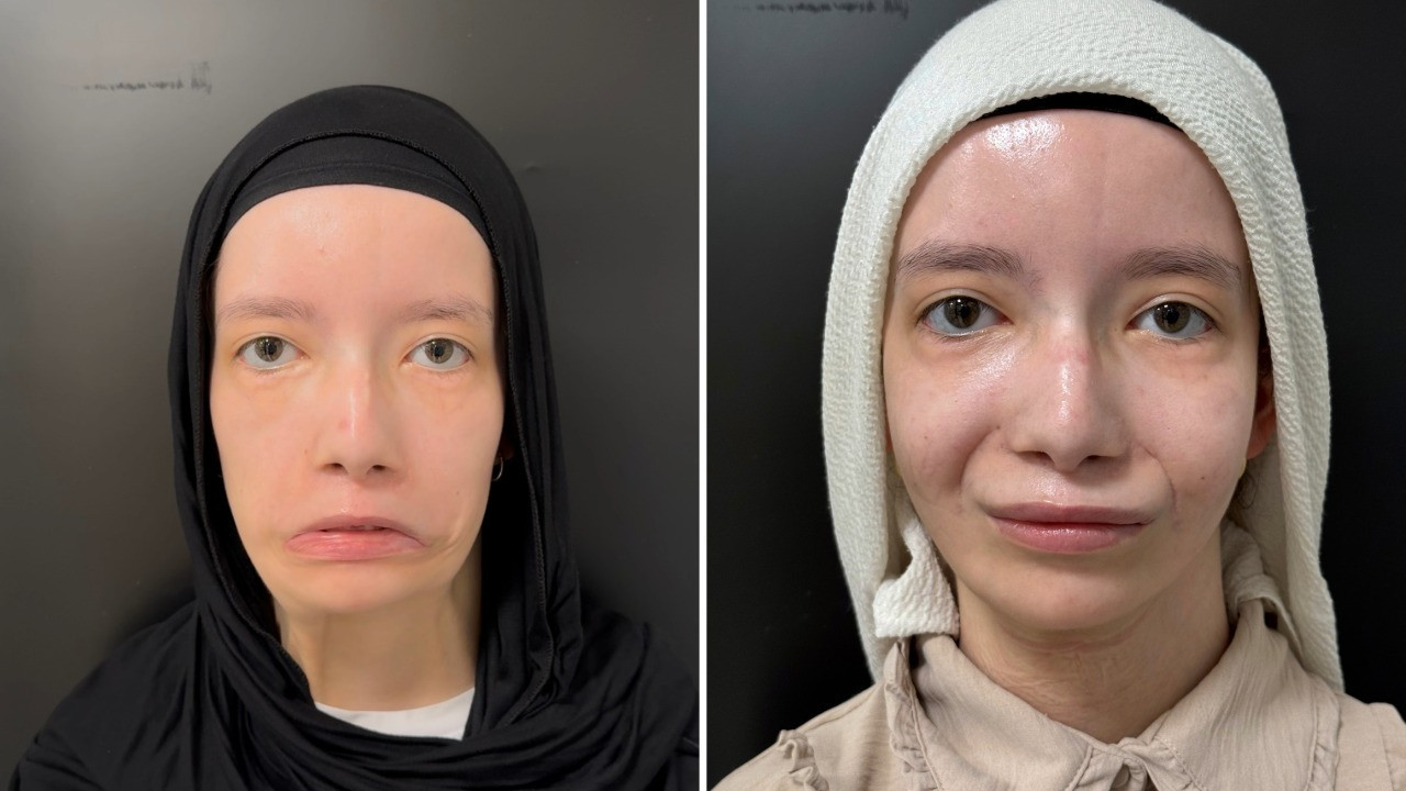 Mimiksiz doğmuştu: 23 yıl sonra gelen gülümseme