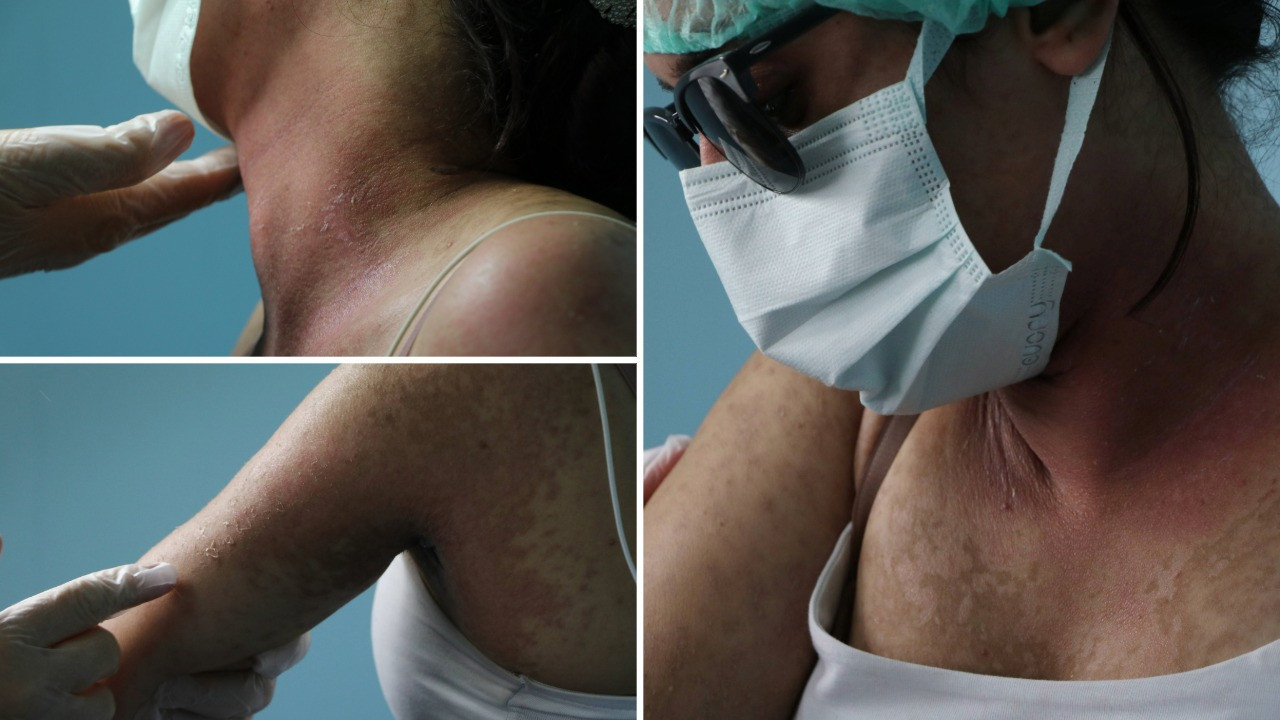 İnternetten aldığı krem yüzünden hastanelik oldu: İçeriği şok etti