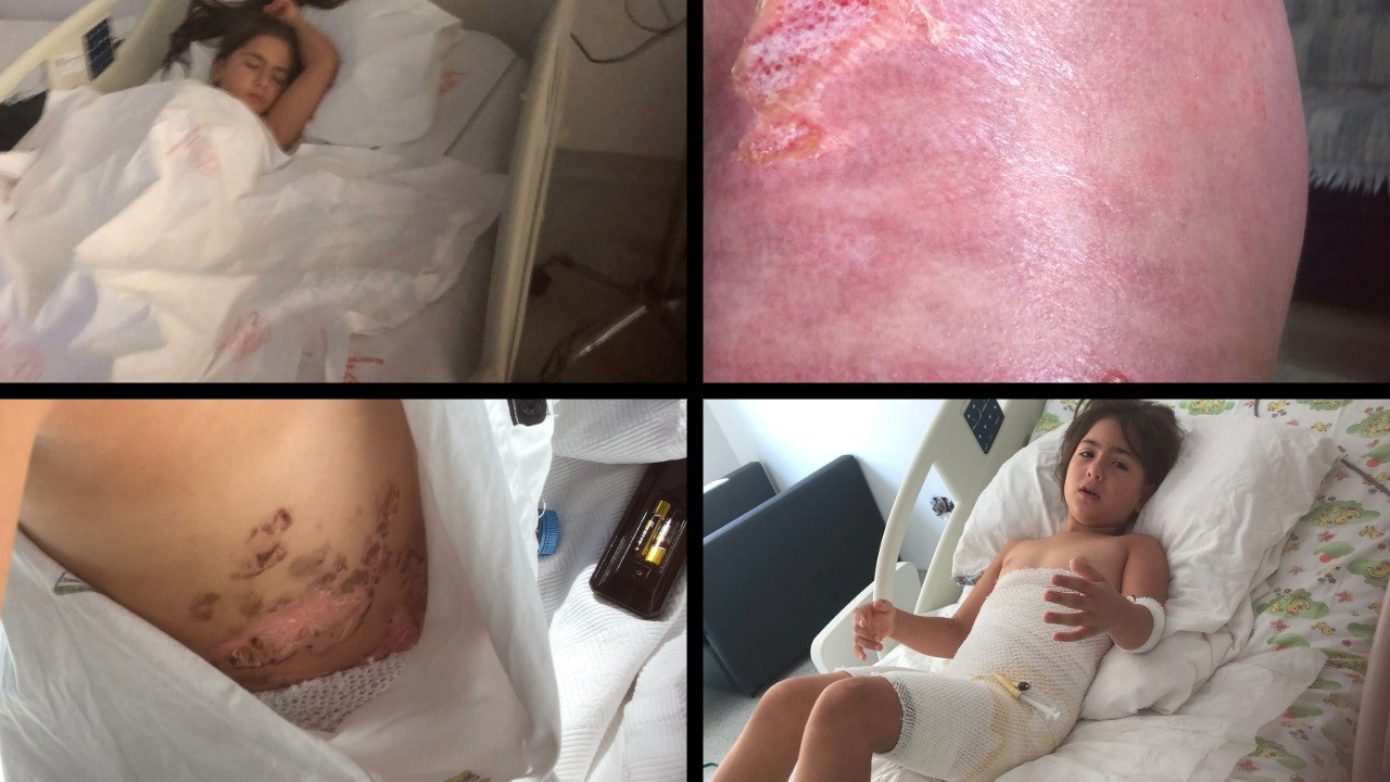 Düğün şovu felaketle bitti: Üzerine azot dökülen çocuk dondu