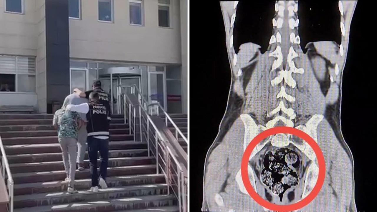 Röntgenle tespit edilen uyuşturucu cerrahi operasyonla çıkarıldı