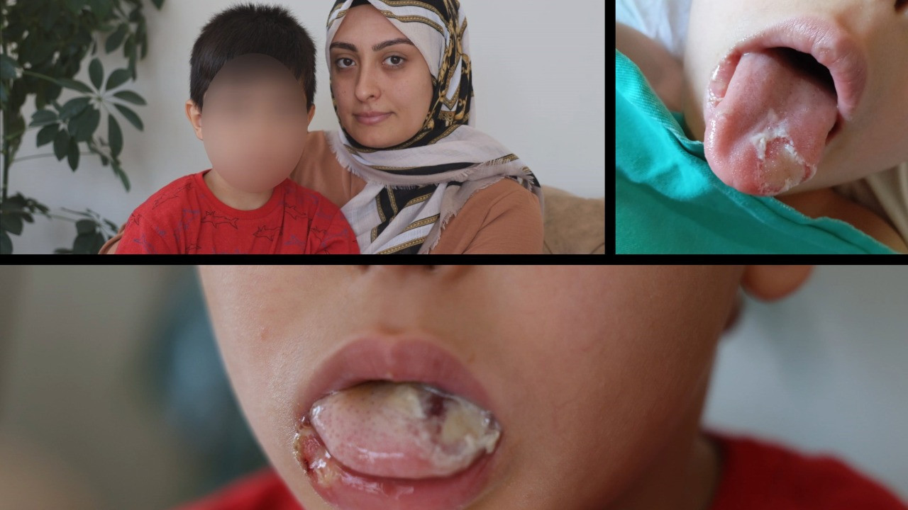 Ameliyatta dili yandı, doktor özür diledi