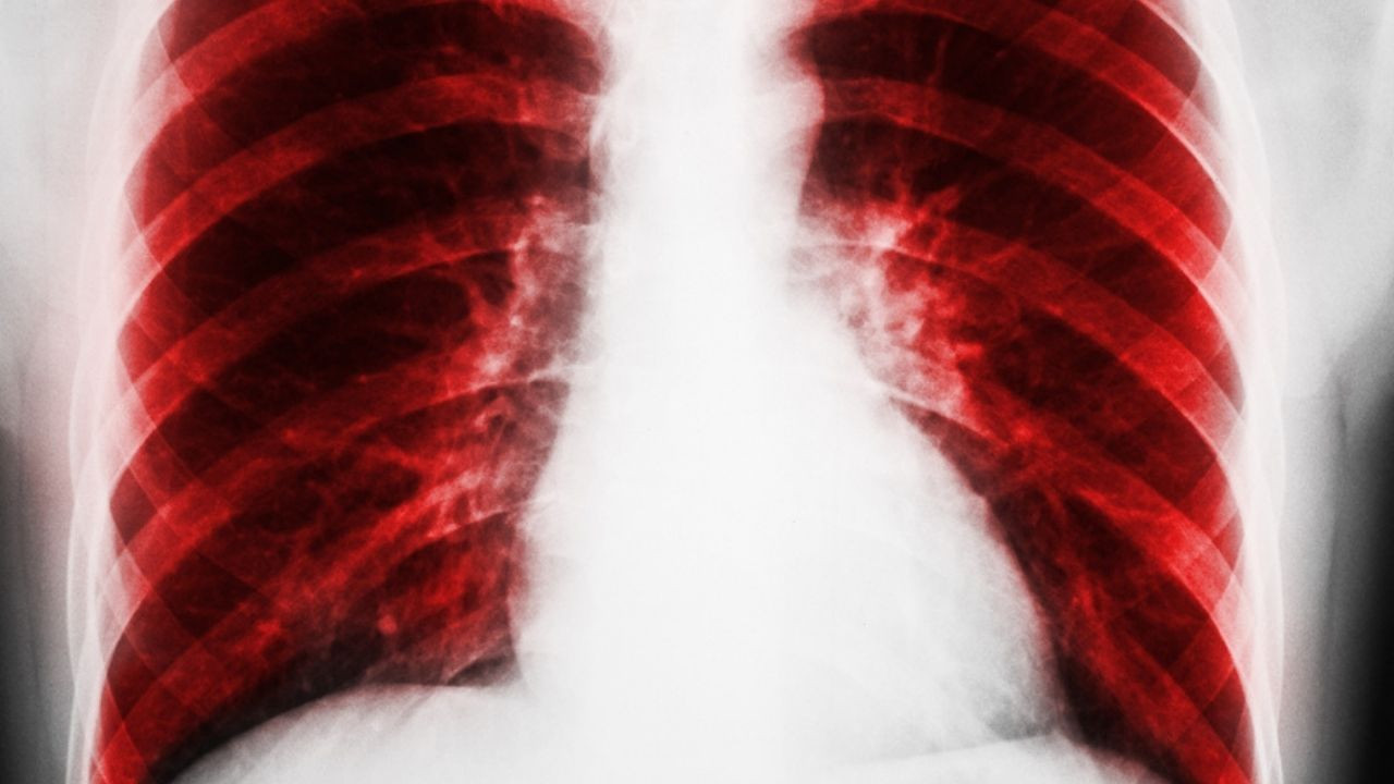 Akciğer hastalarının dikkatine: Bu üç şarkıyı söylemek iyi geliyor