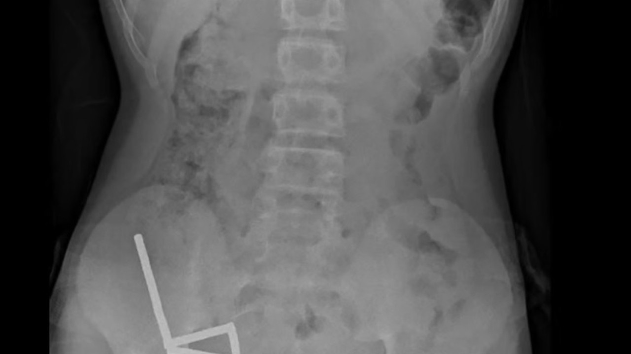 Röntgende ortaya çıktı: Çocuğun bağırsaklarından çıkanlar doktorları şoke etti