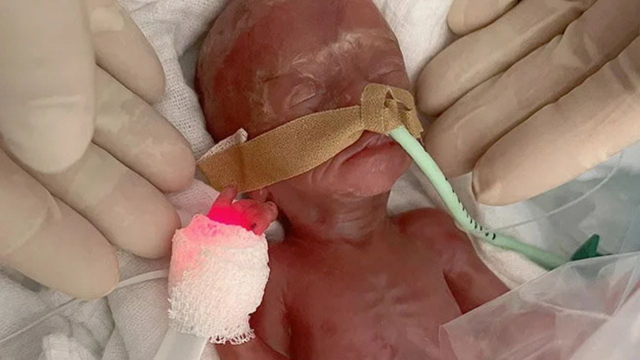 Mucize bebek: 4 ay erken, 300 gram doğdu