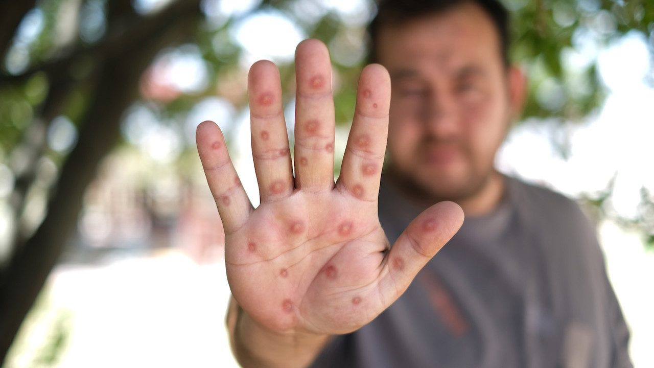 DSÖ: Avrupa'da maymun çiçeği virüsü görüldü