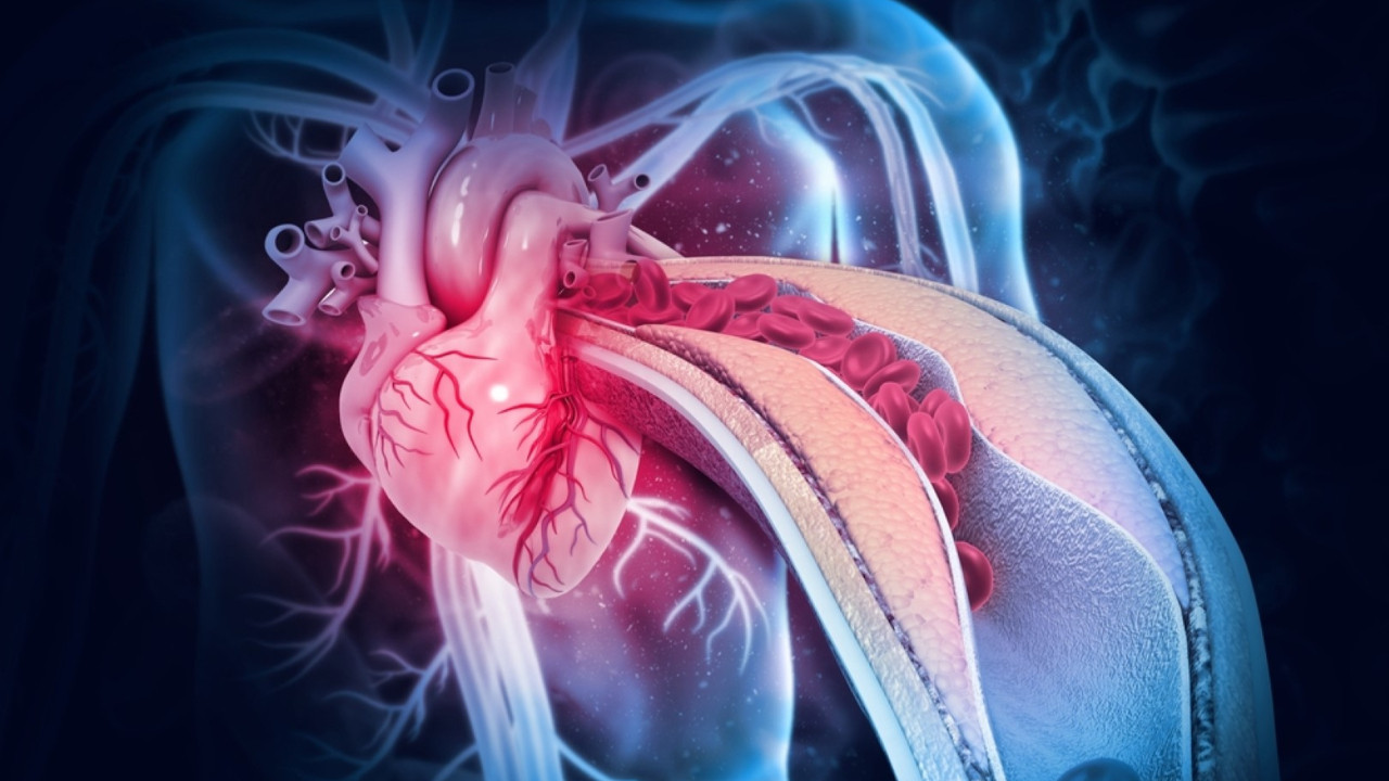 Mikroplastikler erkeklerde damar tıkanıklığını hızlandırıyor