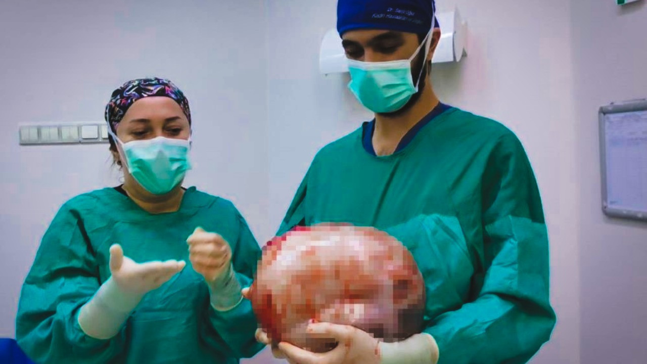 Bu kitle bir kadının karnından çıkarıldı