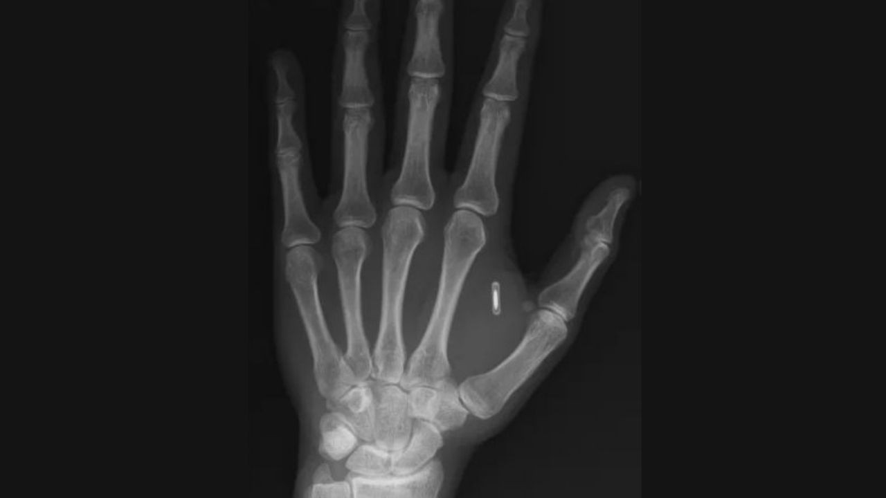 Sihirbazın kâbusu: Eline çip taktırdı, şifreyi unuttu