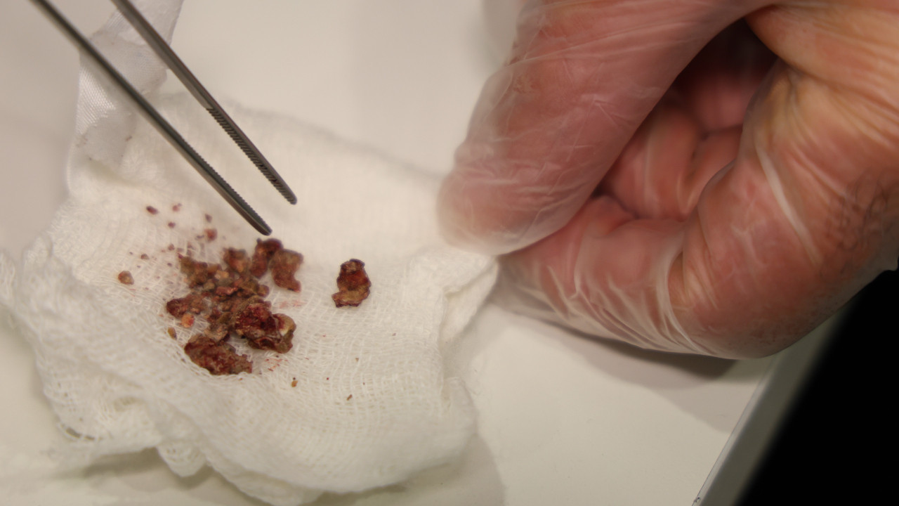 Ameliyat oldu, burnundan çıkanlar şaşırttı