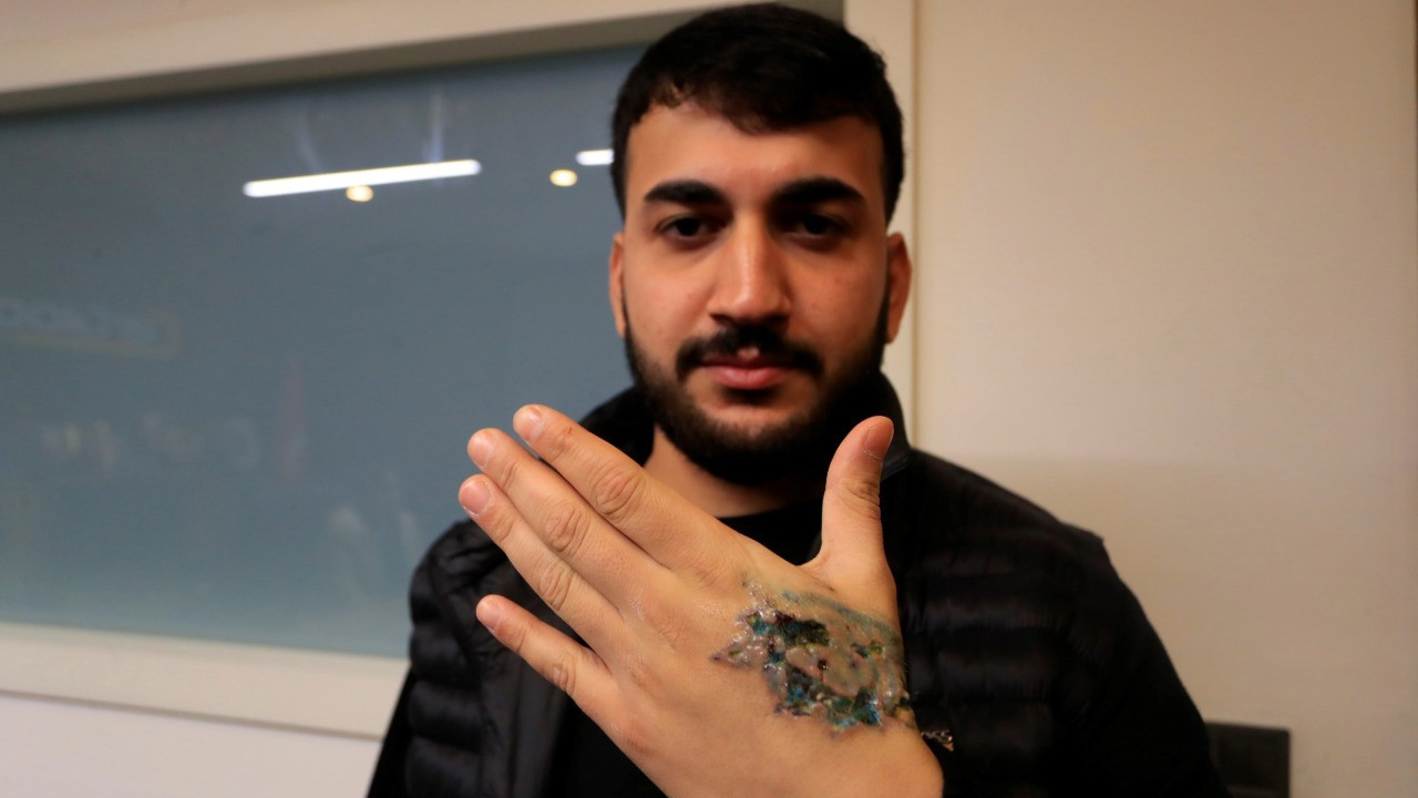 Dövme sildirmek isterken kabusu yaşadı, elindeki dokular öldü