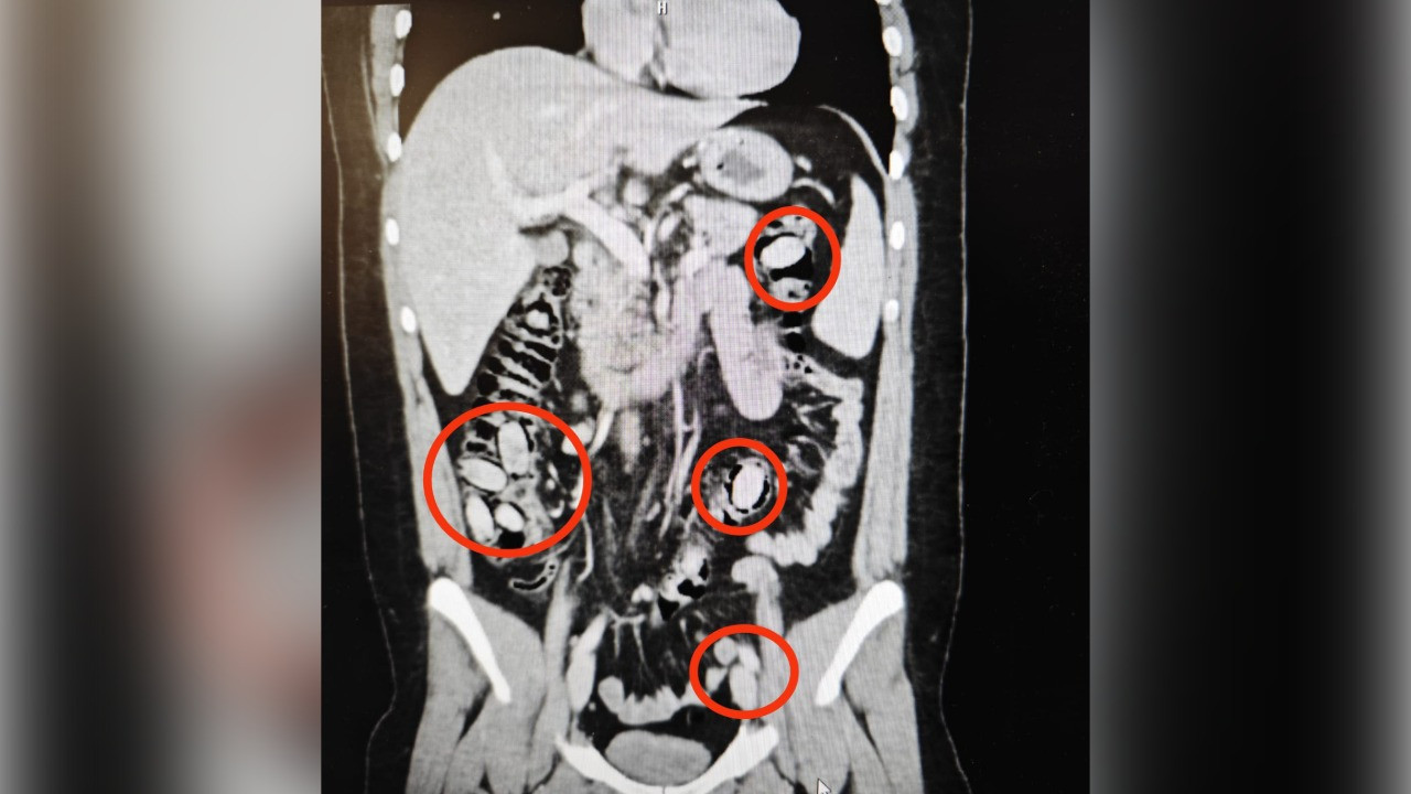 Midesinden 44 kapsül uyuşturucu madde çıktı