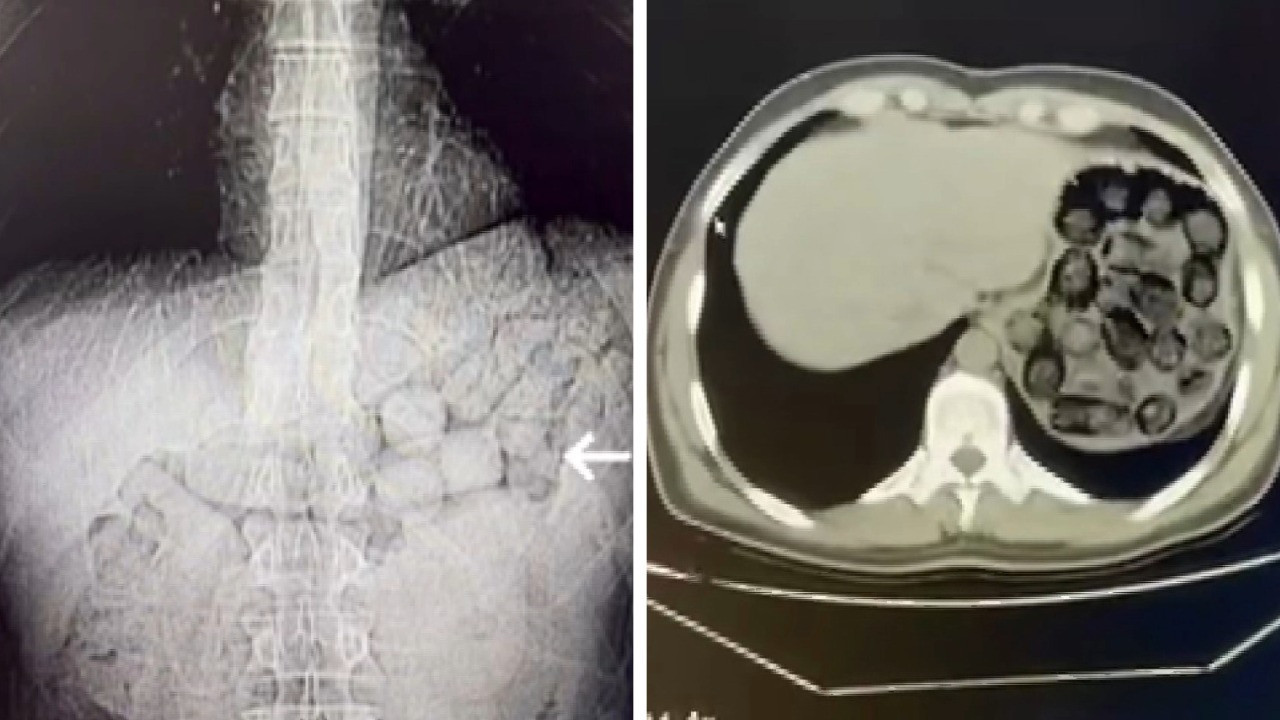 Mide ve bağırsaklarından 91 kapsül metamfetamin çıktı