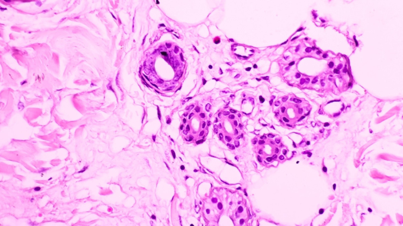 Alzheimer'lı farelere kanser hücreleri naklettiler: Sonuçlar şaşırttı