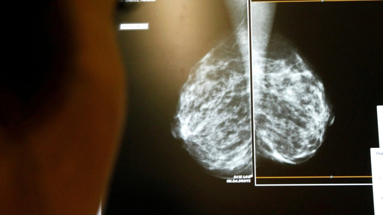 Meme kanseri taramalarında fark yarattı: Geç teşhis riski yüzde 12 azaldı