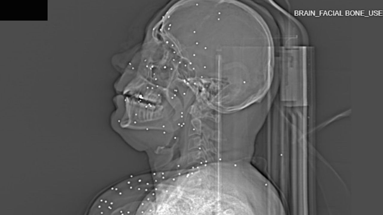 Protestoculara şiddetin boyutu röntgenlerde çıktı