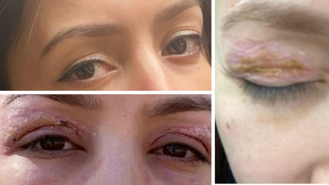 Güzellik salonundaki işlem sonrası gözünde hasar iddiası, şikayeti reddedildi