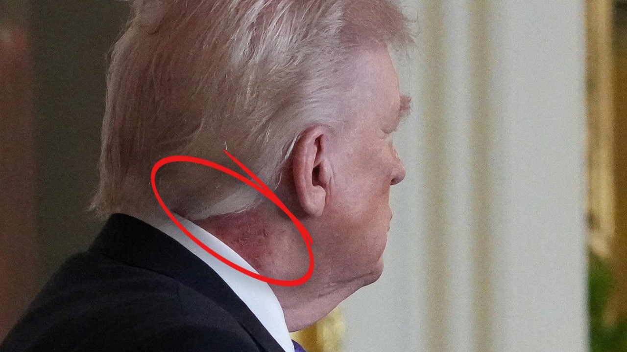 ABD’de gündem Trump’ın kızarıklığı