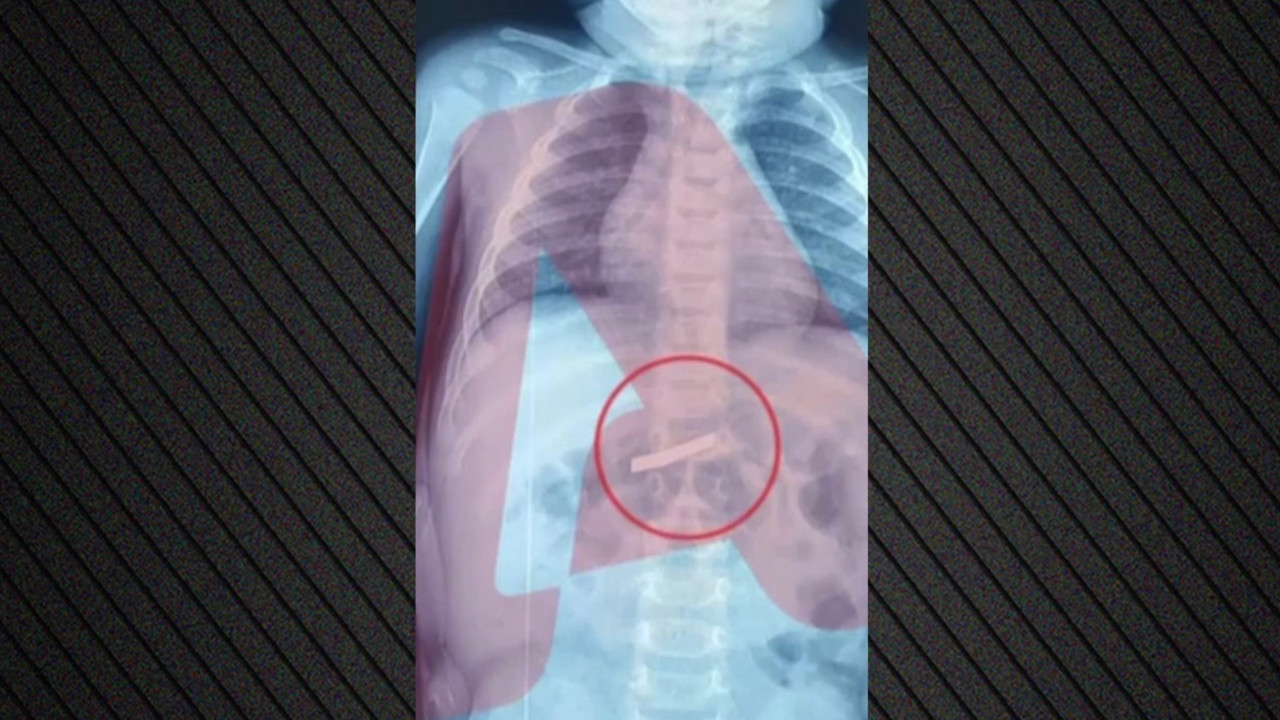 3 yaşındaki çocuk jilet yuttu