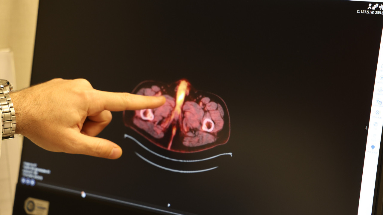 Dünyada 60 kişide görüldü, 10'u Türkiye'de: Penisi alındı, hayat kalitesi arttı