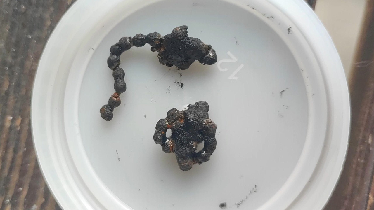 5 yaşındaki çocuğun burnundan çıkan şey hayrete düşürdü