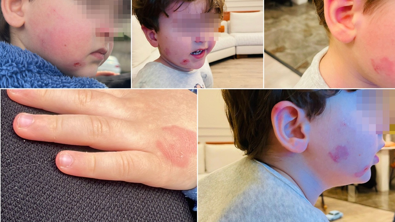 Kreşe bıraktığı 2 yaşındaki çocuğunu bu halde geri aldı