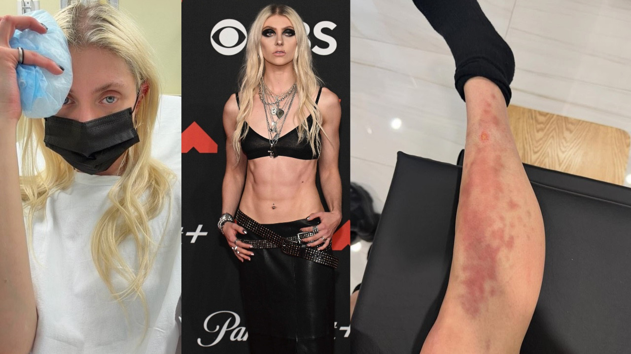 Genç şarkıcıyı örümcek ısırdı: Hastaneye kaldırıldı