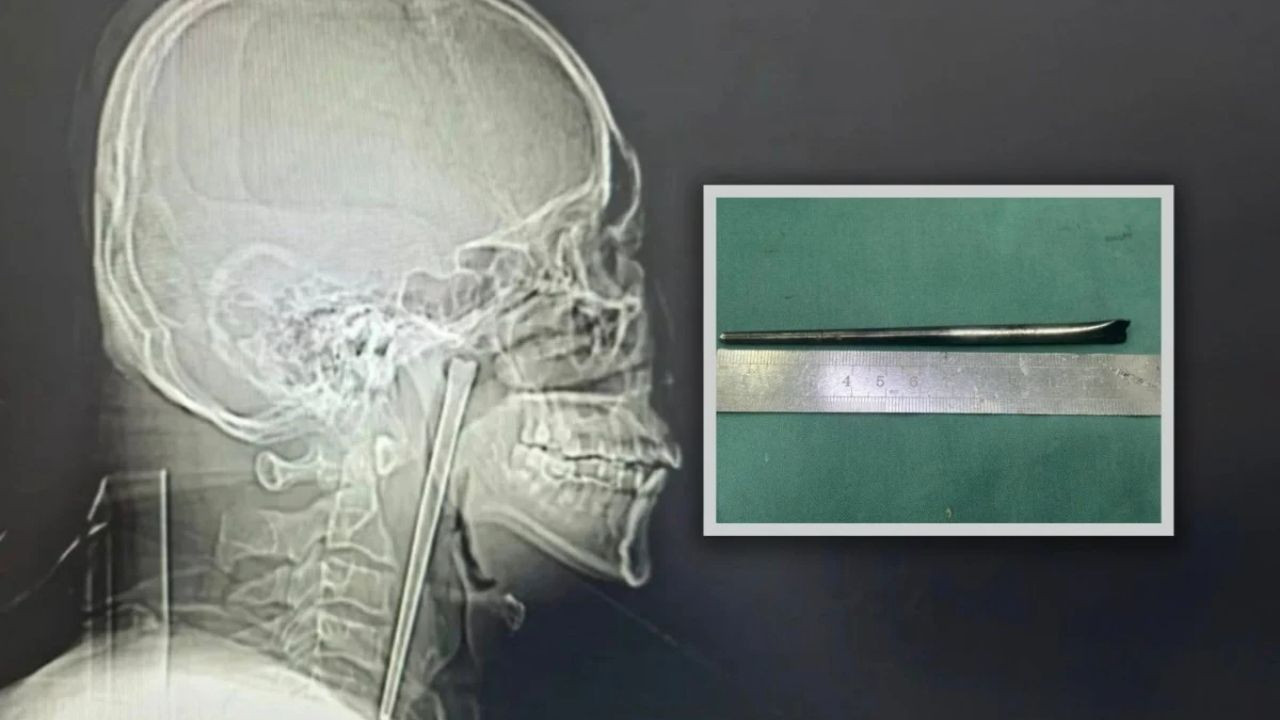 Sekiz yıl boğazında metal çubukla yaşadı