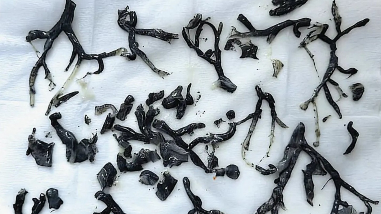 Akciğerlerinden çıkan tıp dünyasını şaşkına çevirdi