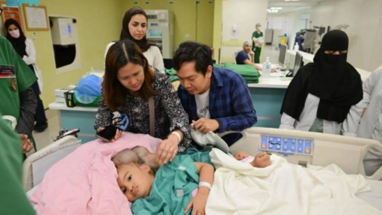 Yapışık ikizleri ayırmak 18,5 saat sürdü