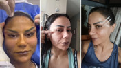 220 bin TL'lik estetik faciası: Vadettikleri güzellik 3 gün sürdü