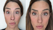 Deney için yüzünün yarısına botoks yaptı: İşte çarpıcı sonuç