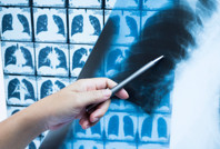 Sağlıklı kişilerdeki kanser vakalarının sebebini buldular