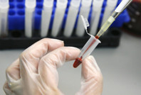 Dünyada 39 milyon kişi HIV/AIDS