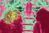 Kanser tedavisinde devrim: Son evredeki hastalara bu virüs umut oldu!