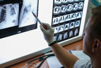 Akciğer kanserinde endişe yaratan bulgu: Giderek artıyor