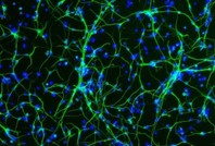 Alzheimer'da çarpıcı keşif: 'Babadan geliyor'