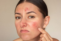 Dermatolog uyardı: Cildinizdeki bu izler kanserin habercisi olabilir