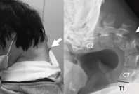 Sürekli telefonuna bakan 25 yaşındaki gencin boynu yamuldu