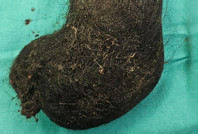 Aileler dikkat: 9 yaşındaki çocuğun midesinden çıktı