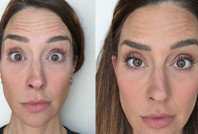 Deney için yüzünün yarısına botoks yaptı: İşte çarpıcı sonuç