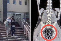 Röntgenle tespit edilen uyuşturucu cerrahi operasyonla çıkarıldı