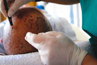 Resmi Gazete'de yayınlandı: Saç ekiminde yeni dönem