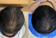 Kelliğe umut: 2 ayda saç çıkaran formül yaptılar