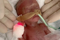 Mucize bebek: 4 ay erken, 300 gram doğdu