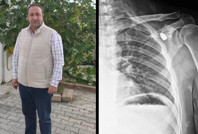 Vücudunda gezen mermi yıllar sonra çıkarıldı