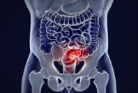 50 yaş altı kadınlar dikkat: Kolorektal kanser riskini artırıyor