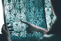 Alzheimer'da umut veren bileşik: Belirtileri tersine çevirdi