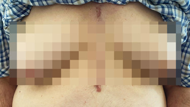 Tıp dünyası şokta: 76 yaşındaki adamın memeleri büyüdü