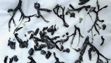 Akciğerlerinden çıkan tıp dünyasını şaşkına çevirdi